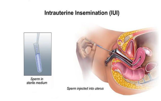 IUI